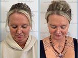 Breakthrough needle-free treatment that experts claim can get rid of neck fat in just 20 minutes becomes available in the UK