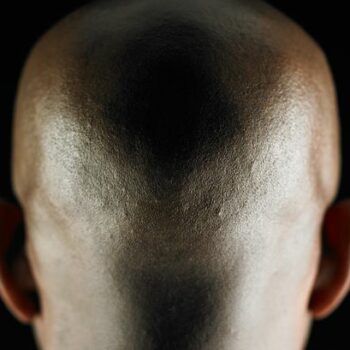 Breakthrough in baldness treatment as sugar found to stimulate hair growth