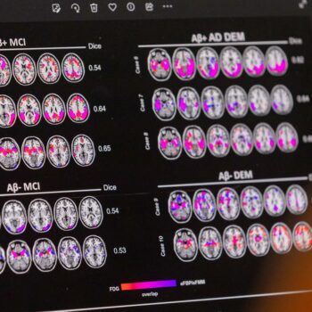 Alzheimer-Therapie: Was der Rückschlag in der Alzheimer-Therapie bedeutet