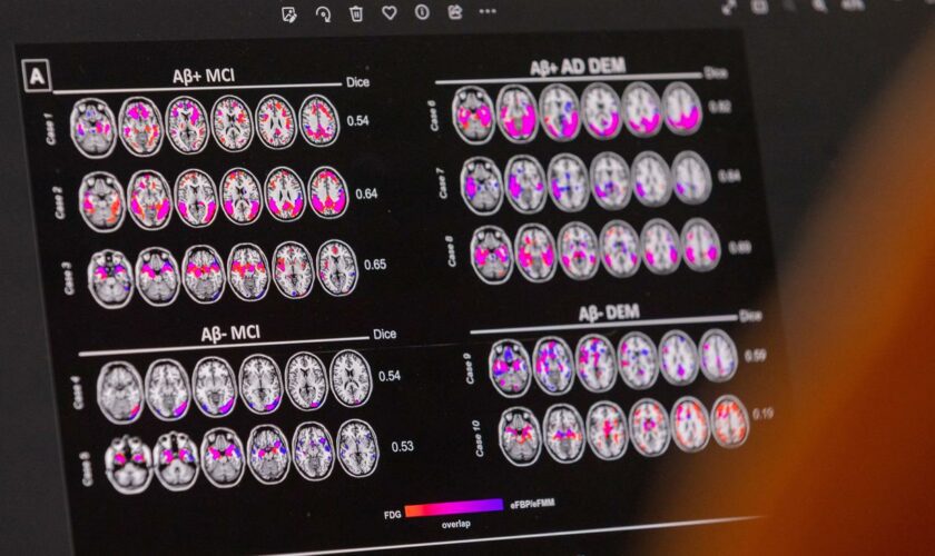 Alzheimer-Therapie: Was der Rückschlag in der Alzheimer-Therapie bedeutet