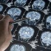 Europa rechaza la aprobación para Alzheimer de lecanemab, un fármaco que ralentiza el deterioro cognitivo