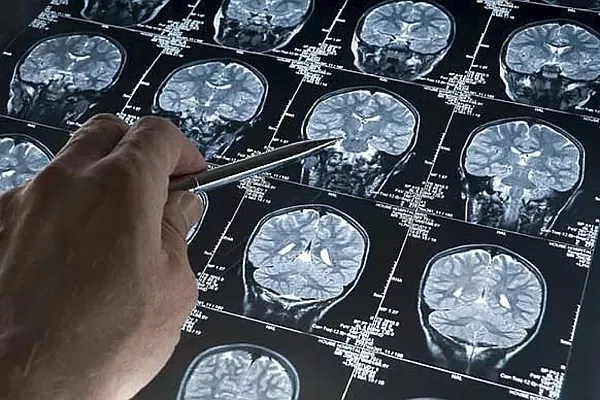 Europa rechaza la aprobación para Alzheimer de lecanemab, un fármaco que ralentiza el deterioro cognitivo