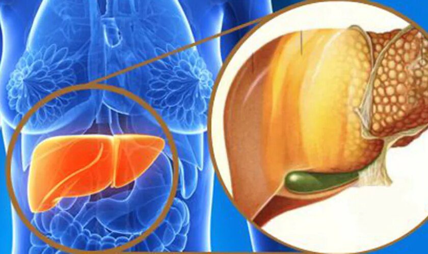 ¿Qué alimentos debemos evitar para reducir la probabilidad de sufrir hígado graso?