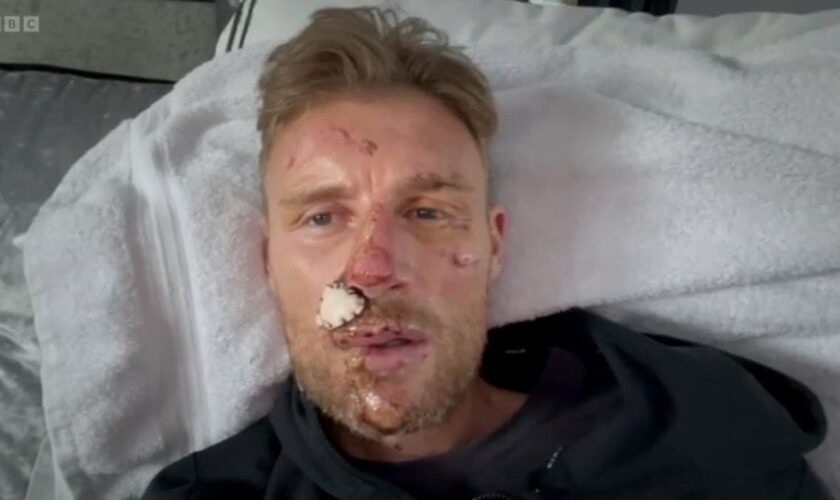 Freddie Flintoff reveals full facial injuries in tearful home video after Top Gear crash