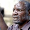 A man in the Democratic Republic of Congo has lesions on his face after contracting mpox in the latest outbreak. Pic: Reuters