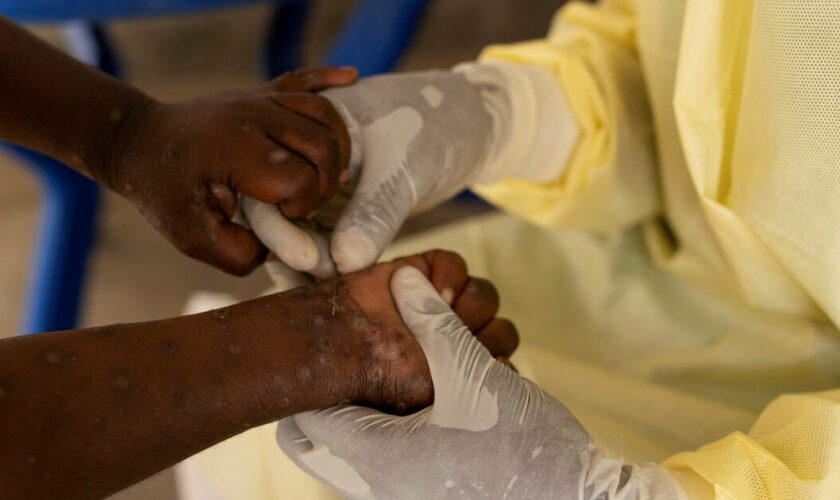 Variole du singe - Mpox : le nouveau variant découvert en Suède, une première hors d’Afrique