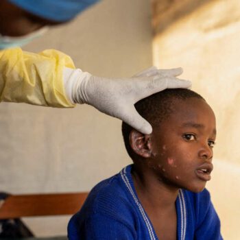 Virus de la mpox : pourquoi les autorités s’inquiètent