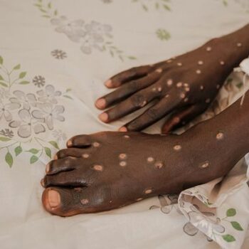 Mpox sufferer details painful symptoms to look for as horror virus continues to spread