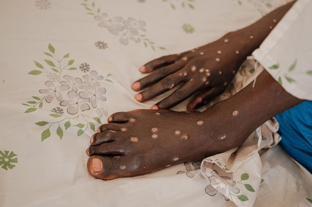 Mpox sufferer details painful symptoms to look for as horror virus continues to spread