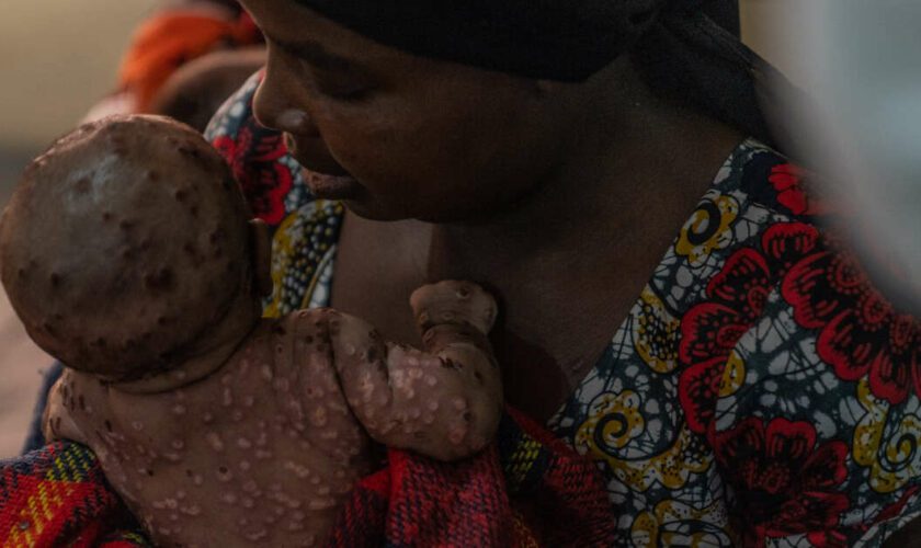 En Afrique, l’inquiétude autour des cas de mpox touchant les enfants