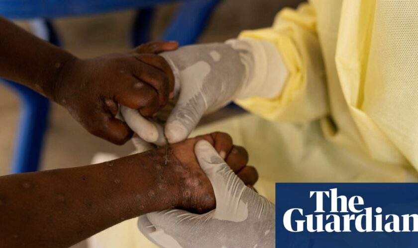 Africa CDC declares mpox outbreak a public health emergency