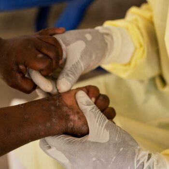 Afrika: WHO ruft wegen Mpox weltweite Notlage aus