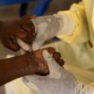 Mpox : éruption cutanée, fièvre… quels sont les symptômes de la nouvelle souche ?