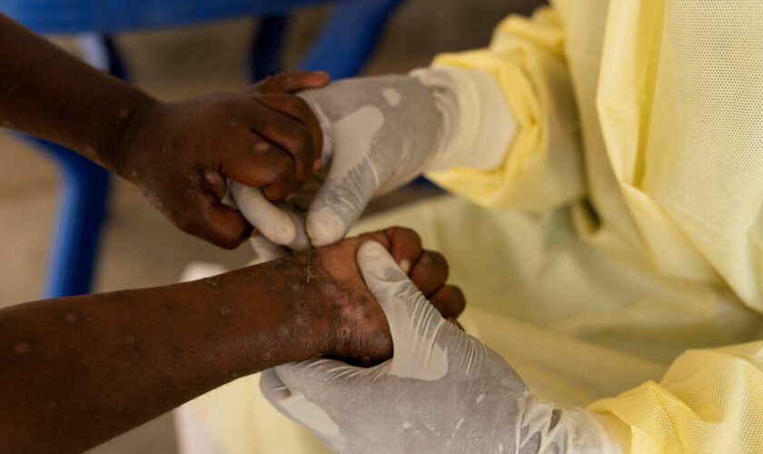 Mpox : éruption cutanée, fièvre… quels sont les symptômes de la nouvelle souche ?