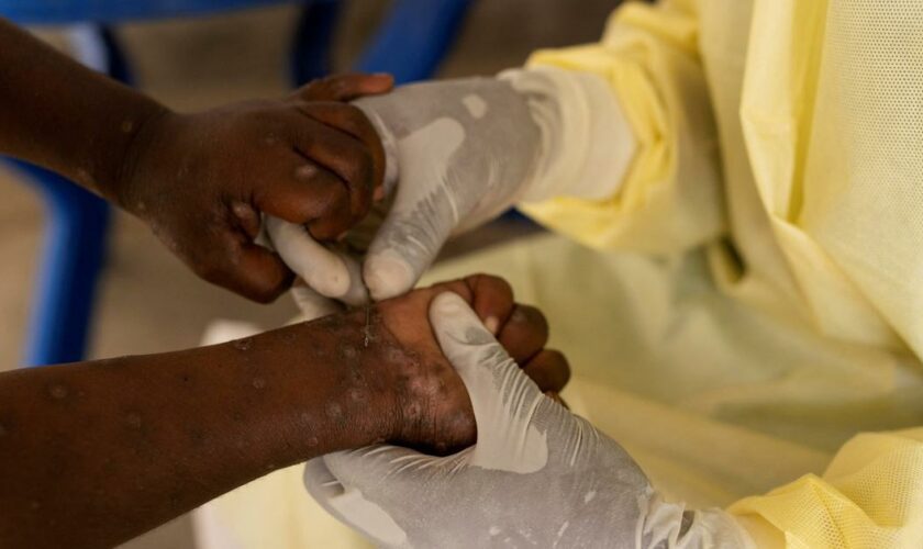 Mpox : le plus haut niveau d'alerte mondiale déclenché par l’OMS