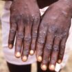 Mpox outbreak declared a public health emergency in Africa