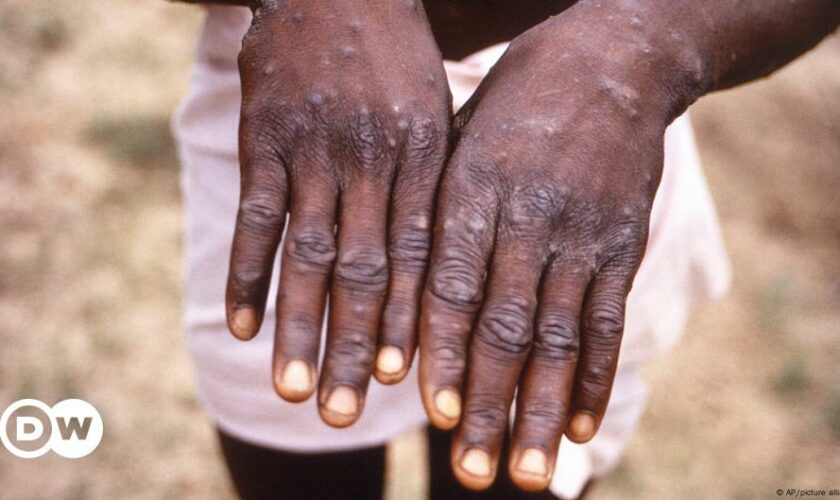 Mpox outbreak declared a public health emergency in Africa