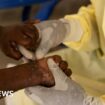 Sweden announces first case of more contagious mpox found outside Africa