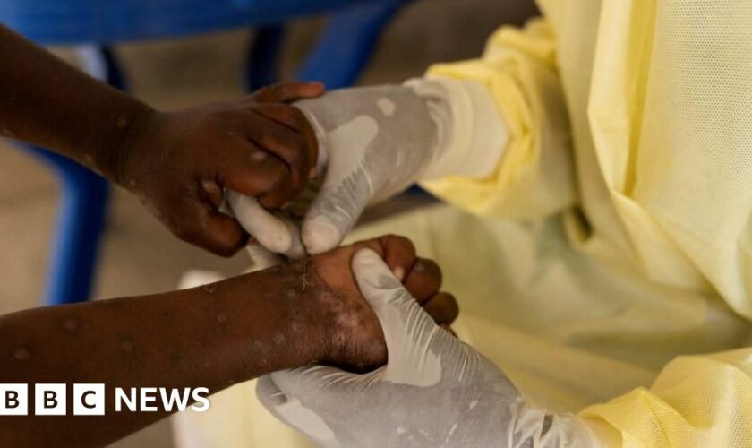 Sweden announces first case of more contagious mpox found outside Africa