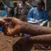 Mpox : épicentre de l'épidémie, la RD Congo reçoit ses premiers vaccins