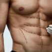 'Six-pack surgery' gaining popularity among men, say plastic surgeons