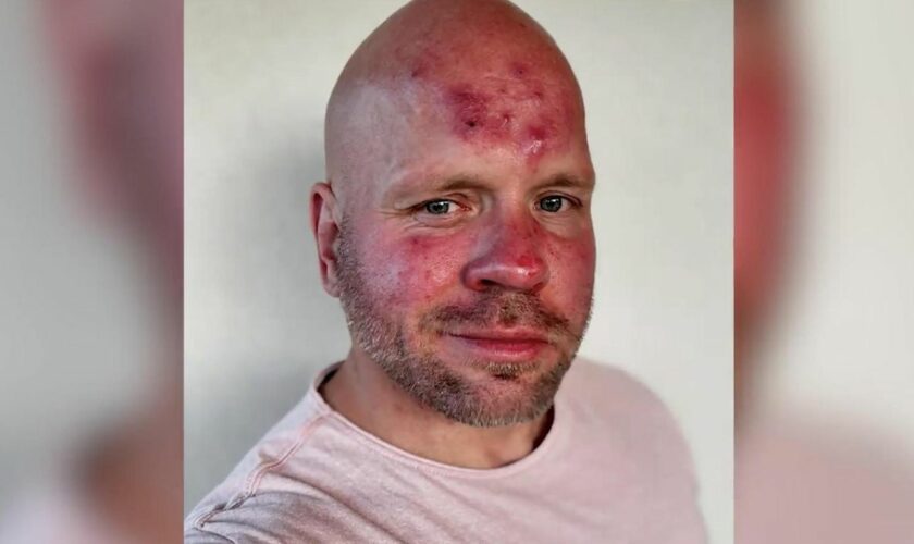 Hauterkrankung: Ricardo Lange über Rosacea: "Schmerzen kann ich aushalten, aber ich schäme mich"