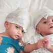 Conjoined one-year-old twin girls Minal and Mirha who were separated during an operation at Ankara Bilkent City Hospital in Turkey on 19 July 2024. Work was supported by Gemini Untwined, a charity founded by Professor Noor ul Owase Jeelani from Great Ormond Street Hospital. handout from charity