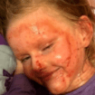 Daughter's 'endless battle' with horror eczema skin condition as mum issues warning