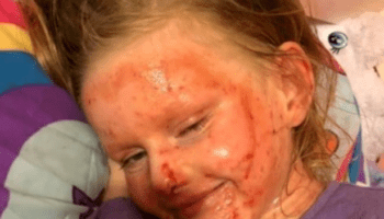 Daughter's 'endless battle' with horror eczema skin condition as mum issues warning