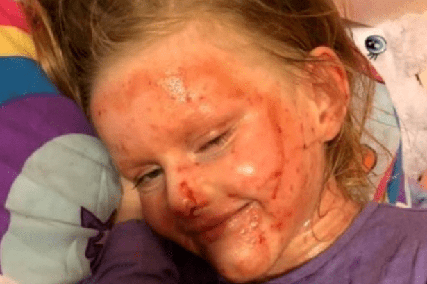 Daughter's 'endless battle' with horror eczema skin condition as mum issues warning