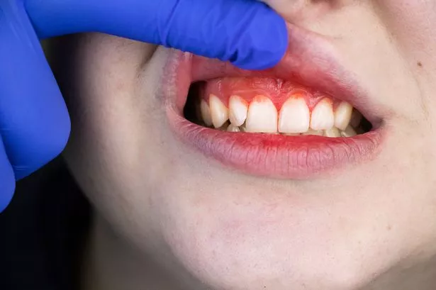 'I'm a dentist - watch out for this health mistake that worsens gum disease'