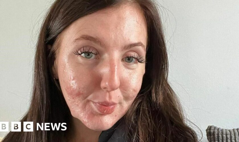 Acne fighter films her skin journey to help others