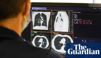 UK can expect ‘tsunami of missed cancers’ in wake of pandemic, experts say