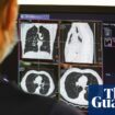 UK can expect ‘tsunami of missed cancers’ in wake of pandemic, experts say