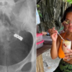 Woman accidentally swallows wedding ring while taking vitamins, X-ray shows