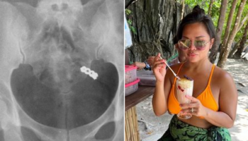 Woman accidentally swallows wedding ring while taking vitamins, X-ray shows