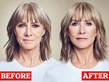 I aged overnight when I hit 60. Now I look and feel 10 years younger thanks to a dramatic treatment: Fashion designer KAREN MILLEN reveals her beauty secret