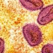 Mpox: Erster Fall neuer Mpox-Variante in Deutschland gemeldet