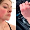 'I'm allergic to winter - five minutes outside in snow leaves me covered in blisters'