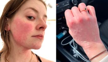 'I'm allergic to winter - five minutes outside in snow leaves me covered in blisters'