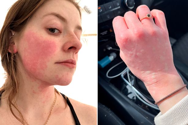 'I'm allergic to winter - five minutes outside in snow leaves me covered in blisters'