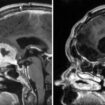 Scan of Doreen Adams head before (left) and after (right) an operation by consultant neurosurgeon, Anastasios Giamouriadis, to remove a brain tumour through her eyebrow. Pic: NHS Grampian