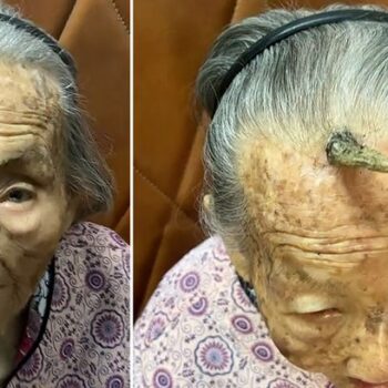 Woman, 107, credits 10cm horn growing out of her forehead with granting her long life