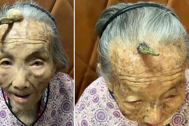 Woman, 107, credits 10cm horn growing out of her forehead with granting her long life