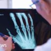 AI to help doctors spot broken bones on X-rays