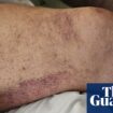 Perth man treated for scurvy as cost-of-living crisis brings back ‘disease of the past’