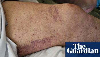 Perth man treated for scurvy as cost-of-living crisis brings back ‘disease of the past’