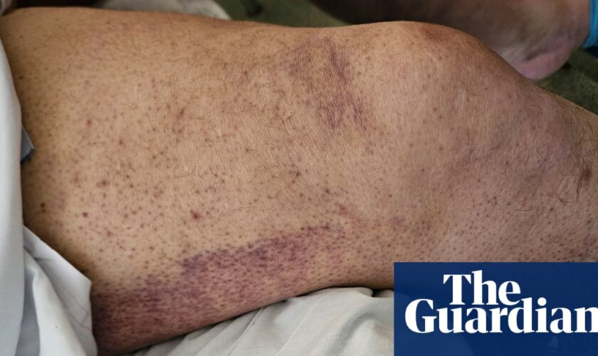 Perth man treated for scurvy as cost-of-living crisis brings back ‘disease of the past’