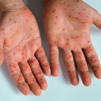 New case of Mpox Clade 1b detected in UK amid health warnings