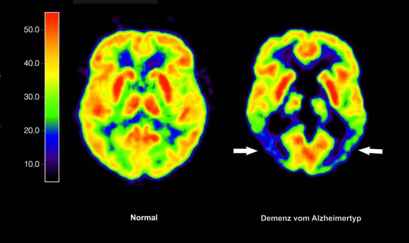 Haben die Amyloid-Plaques schon irreversible Schäden im Gehirn angerichtet, nützt ihre Entfernung nichts mehr. (Archivbild) Foto